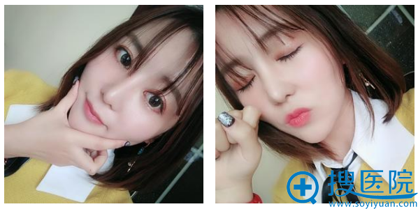 在<!--<i data=20240710 data-id=9134></i>-->做完自体脂肪填充一年了还是这么美 在<!--<i data=20240710 data-id=9134></i>-->做完自体脂肪填充一年了还是这么美