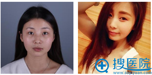 这是我哦之前单眼皮的照片 这是我哦之前单眼皮的照片