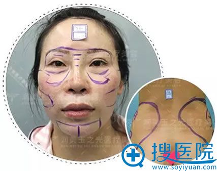 王明利博士为我设计的手术方案 王明利博士为我设计的手术方案