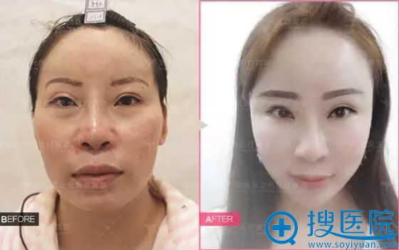 北京玉之光王明利脂肪填充案例对比图 北京玉之光王明利脂肪填充案例对比图