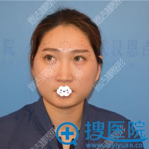 武汉恩吉娜段小兵整形怎么样?鉴于医院正规做自体脂肪面部填充
