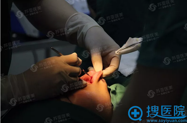 在口腔内部合适部位做小切口 在口腔内部合适部位做小切口