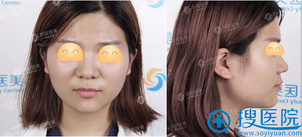 苏亚美联臣假体垫下巴术后2周效果 苏亚美联臣假体垫下巴术后2周效果