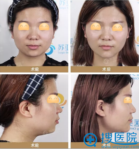 石家庄苏亚美联臣假体隆下巴术前术后对比 石家庄苏亚美联臣假体隆下巴术前术后对比