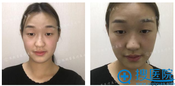 单眼皮照片 单眼皮照片