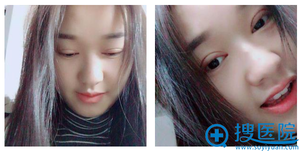<!--<i data=20240710 data-id=12070></i>-->双眼皮案例13天睁眼闭眼细节图 <!--<i data=20240710 data-id=12070></i>-->双眼皮案例13天睁眼闭眼细节图