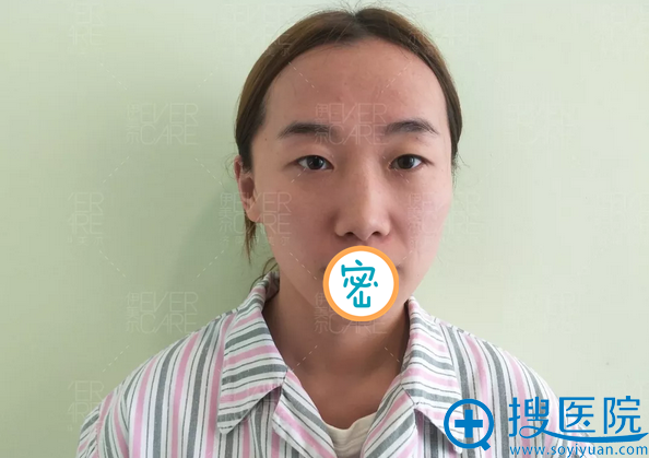 作为济南伊美尔的员工我给自己谋福利 找王清峰做了眼综合手术