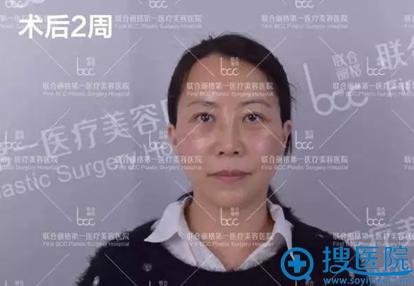 自体脂肪填充和注射除皱两周效果 自体脂肪填充和注射除皱两周效果