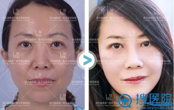 杨大平自体脂肪填充案例对比图 杨大平自体脂肪填充案例对比图