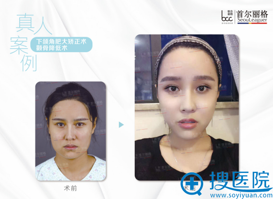 <!--<i data=20240710 data-id=12465></i>-->洪性范院长下颌角和颧骨手术案例 <!--<i data=20240710 data-id=12465></i>-->洪性范院长下颌角和颧骨手术案例