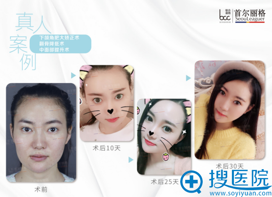 <!--<i data=20240710 data-id=12465></i>-->洪性范做的下颌角+颧骨+面部提升案例 <!--<i data=20240710 data-id=12465></i>-->洪性范做的下颌角+颧骨+面部提升案例