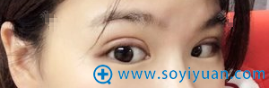 陈德裕切开双眼皮术后5天恢复效果 陈德裕切开双眼皮术后5天恢复效果