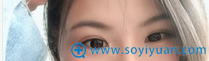 陈德裕双眼皮术后2个月恢复照 陈德裕双眼皮术后2个月恢复照