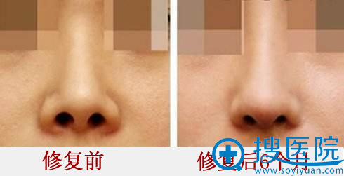 黄见勇膨体隆鼻失败修复术后6个月恢复效果 黄见勇膨体隆鼻失败修复术后6个月恢复效果