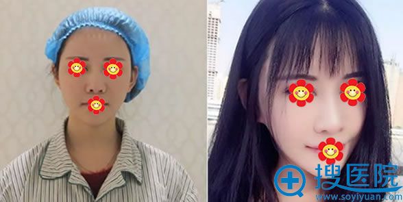 莫莫做鼻综合手术前后效果对比图 莫莫做鼻综合手术前后效果对比图