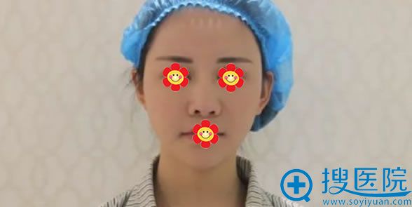 硅胶隆鼻手术失败的照片 硅胶隆鼻手术失败的照片