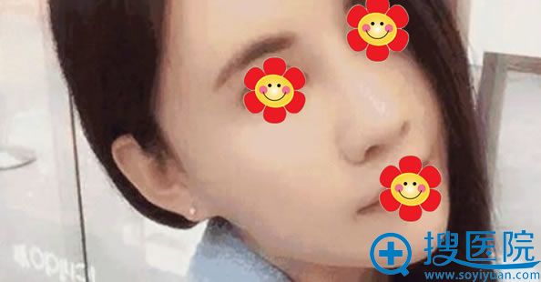 <!--<i data=20240710 data-id=12446></i>-->兰文贤鼻综合案例 <!--<i data=20240710 data-id=12446></i>-->兰文贤鼻综合案例