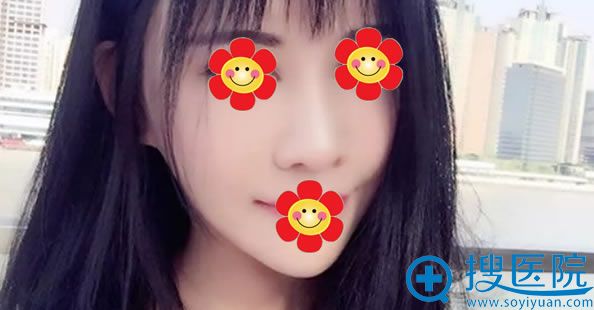 莫琳娜兰文贤院长隆鼻案例 莫琳娜兰文贤院长隆鼻案例