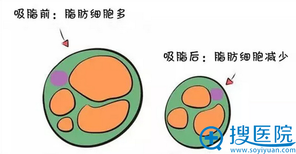 南宁华美吸脂减肥让您瘦胳膊瘦腿瘦腰腹快速瘦身做一个气球人