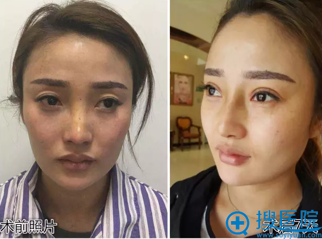 山东威海孙漫整形医院双眼皮和隆鼻案例 山东威海孙漫整形医院双眼皮和隆鼻案例