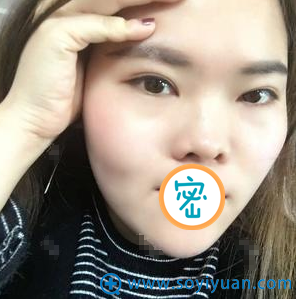 选武汉壹加壹真是太明智 闺蜜都夸我做的硅胶隆鼻精致有质感