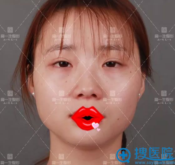 在宝鸡高一生做隆鼻手术前 在宝鸡高一生做隆鼻手术前