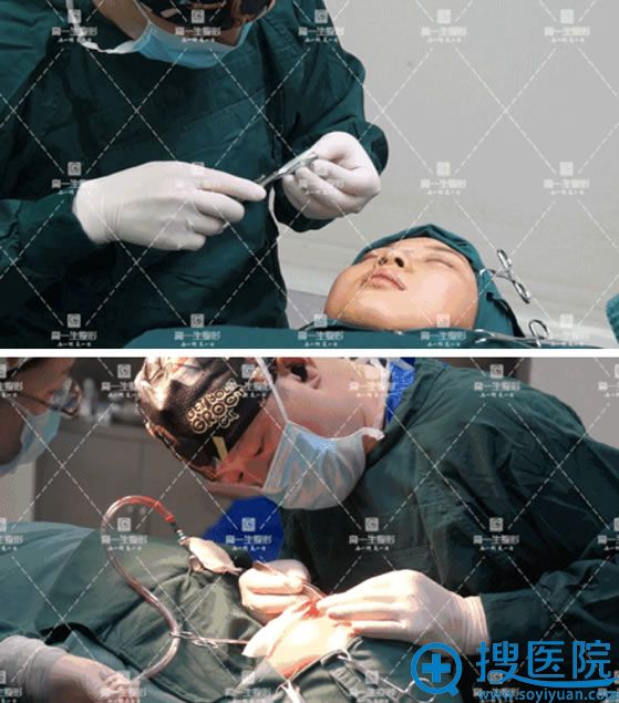 高一生金磊假体隆鼻过程 高一生金磊假体隆鼻过程