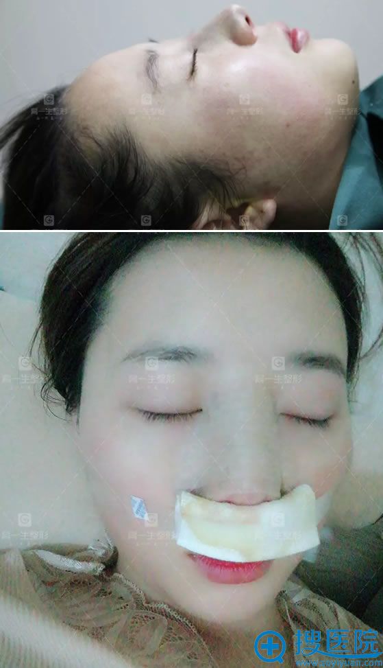 假体隆鼻手术即刻和包扎的效果 假体隆鼻手术即刻和包扎的效果