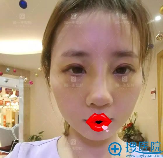 做完隆鼻手术7天拆线的效果 做完隆鼻手术7天拆线的效果