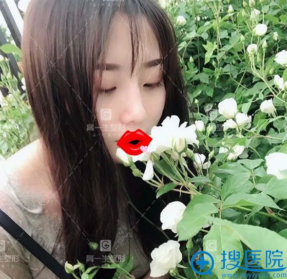 高一生金磊隆鼻案例1个月效果 高一生金磊隆鼻案例1个月效果