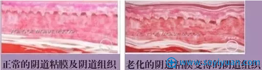 正常阴道粘膜与老化阴道组织对比 正常阴道粘膜与老化阴道组织对比