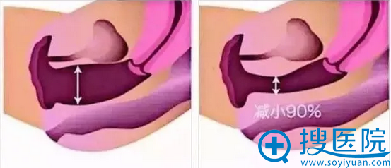 术后使阴道缩紧模拟图对比 术后使阴道缩紧模拟图对比