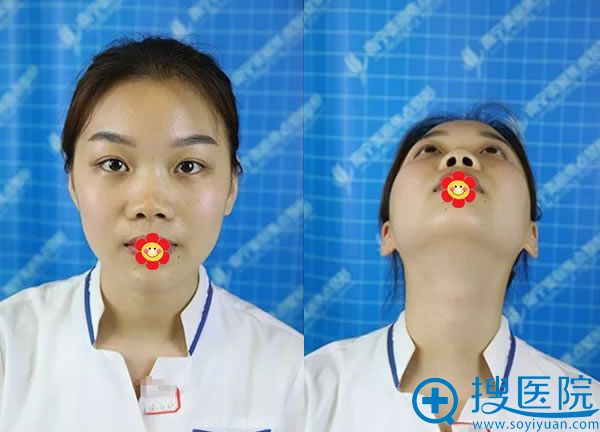美丽焦点员工做隆鼻手术前 美丽焦点员工做隆鼻手术前