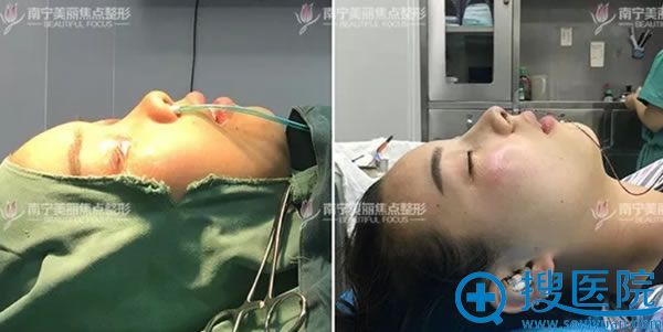 焦俊光院长为丽姐作完鼻综合效果 焦俊光院长为丽姐作完鼻综合效果