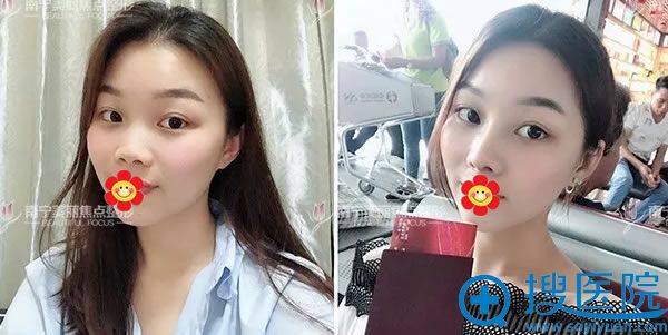 南宁美丽焦点员工隆鼻案例对比图 南宁美丽焦点员工隆鼻案例对比图