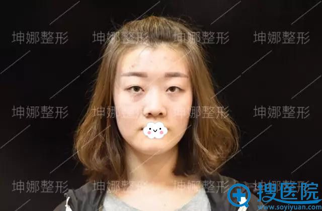 坤娜整形医院杜兰余双眼皮+隆鼻案例 坤娜整形医院杜兰余双眼皮+隆鼻案例