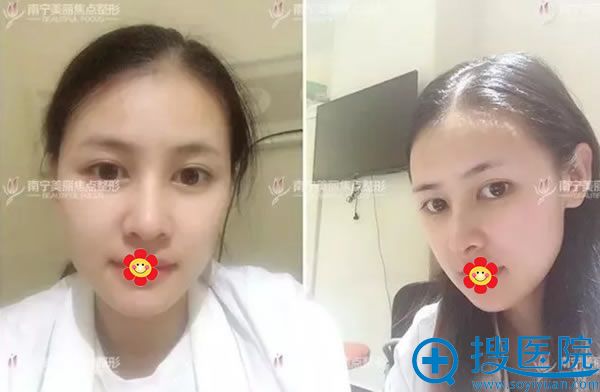 南宁美丽焦点员工做鼻子案例效果 南宁美丽焦点员工做鼻子案例效果
