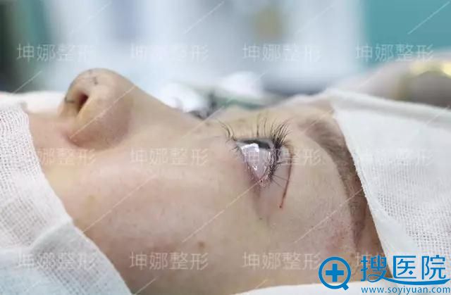 潍坊坤娜杜兰余双眼皮+隆鼻综合整形术后效果 潍坊坤娜杜兰余双眼皮+隆鼻综合整形术后效果