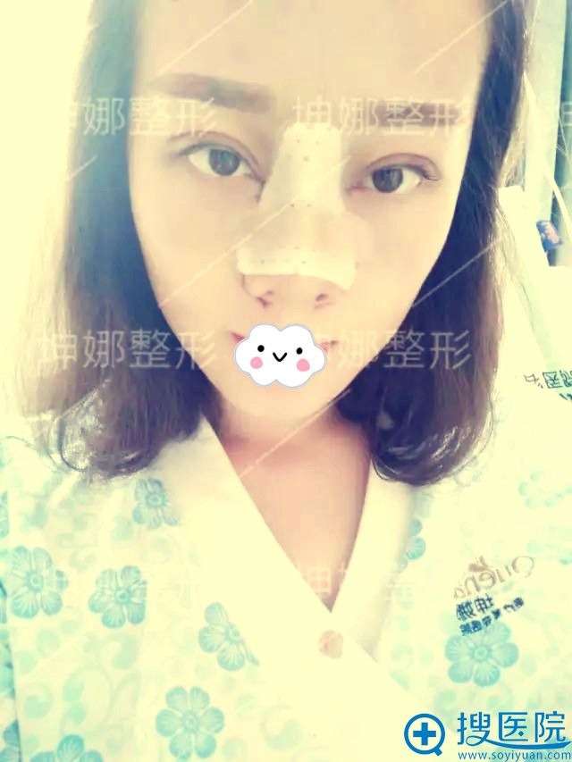 潍坊坤娜双眼皮+鼻部综合整形效果 潍坊坤娜双眼皮+鼻部综合整形效果