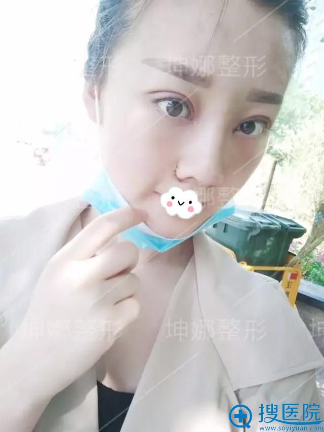 潍坊坤娜双眼皮+隆鼻真人案例效果 潍坊坤娜双眼皮+隆鼻真人案例效果
