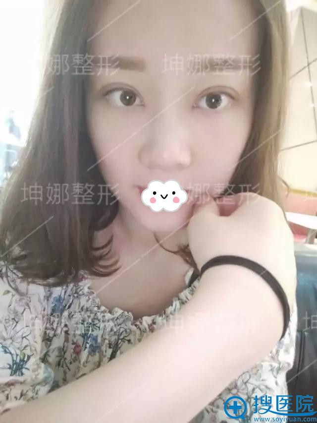 潍坊坤娜整形医院双眼皮真人案例 潍坊坤娜整形医院双眼皮真人案例