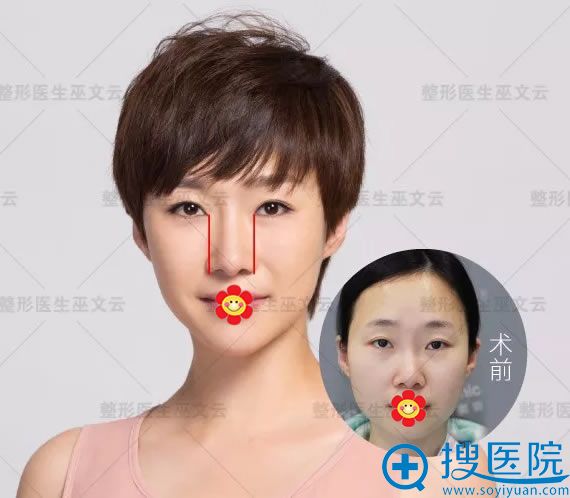 巫文云院长鼻翼缩小案例对比图 巫文云院长鼻翼缩小案例对比图