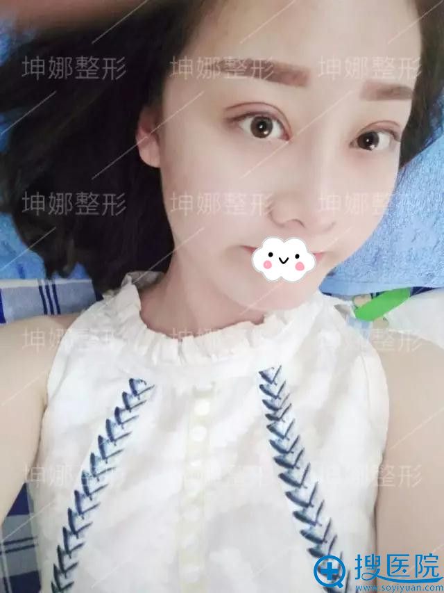 潍坊坤娜医疗美容医院双眼皮案例 潍坊坤娜医疗美容医院双眼皮案例