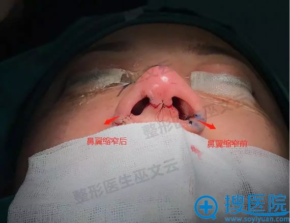 米扬丽格巫文云鼻翼缩小术 米扬丽格巫文云鼻翼缩小术