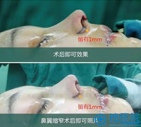 巫文云院长鼻翼缩窄术后即刻效果 巫文云院长鼻翼缩窄术后即刻效果