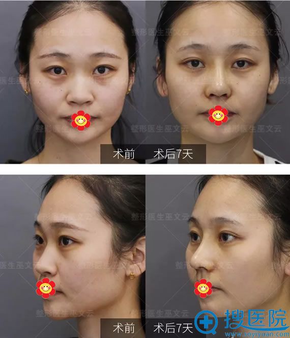 鼻翼缩小术后7天效果对比图 鼻翼缩小术后7天效果对比图