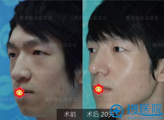 男士做鼻翼缩小案例20天效果对比图 男士做鼻翼缩小案例20天效果对比图