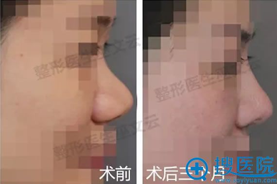 北京米扬丽格鼻翼缩小案例3个月效果 北京米扬丽格鼻翼缩小案例3个月效果
