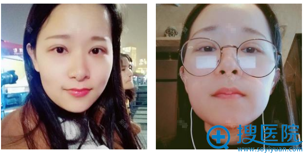长沙美莱邹俊峰做双眼皮怎么样?术后15天恢复效果图 长沙美莱邹俊峰做双眼皮怎么样?术后15天恢复效果图
