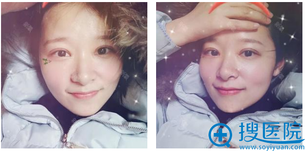 长沙美莱邹俊峰双眼皮案例好看吗?40天效果分享 长沙美莱邹俊峰双眼皮案例好看吗?40天效果分享